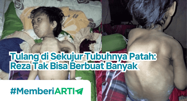 Hidup Dengan Tangan dan Kaki Patah : Reza Tak Punya Biaya Berobat